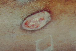 lcera producida por leishmaniasis